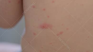 Exploring skin conditions in infants chickenpox. A detailed close up examination of symptoms and care
