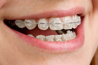 Braces on teeth