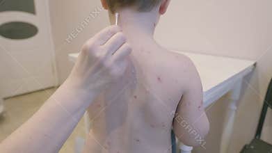 Young Child with a Skin Condition chickenpox Showcasing Their Back Covered in Spots and Patches