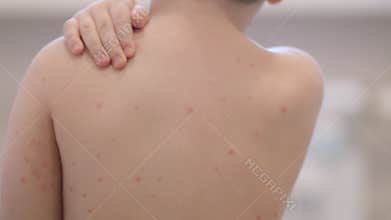 Child with a skin condition chickenpox requiring attentive care and support from family and caregivers