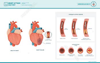 Anatomy of a heart attack