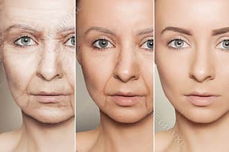 Anti-aging procedures on caucasian woman face