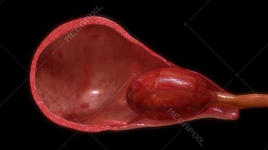 Pulling placenta out of uterus
