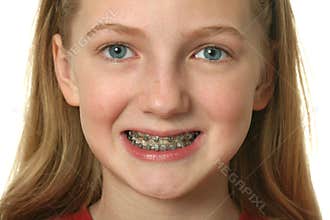 Dental Braces