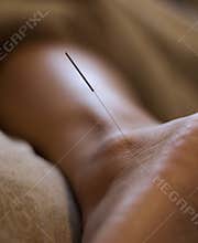 Acupuncture Needle