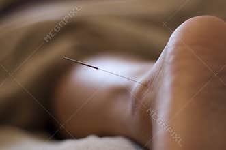 Acupuncture Needle