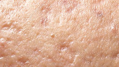 Spherical cystic acne on the skin