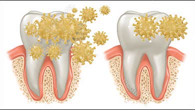 Understanding Immune Response in Periodontitis Through Clear Illustrations Showing Bacteria Effects on Gums and Teeth