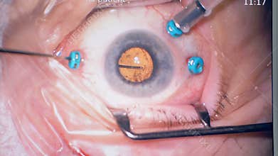 3-port vitrectomy shown in macro view at the preparation stage.