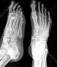 X-RAY of foot