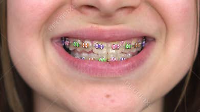 Teen girl with braces smiling close-up. Girl with colored braces on her teeth.