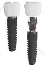 Dental implant. Elements view.