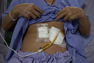 Patient show tube on stomach for feeding food