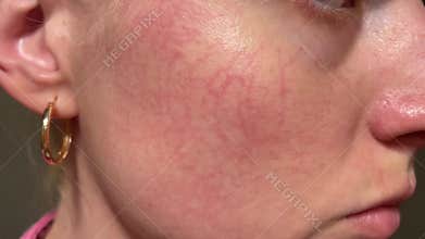 Close-up of facial skin with visible broken capillaries and redness