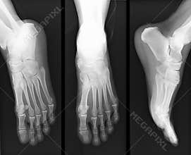 Foot x-ray