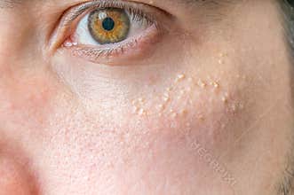 Milia (Milium) - pimples around eye on skin