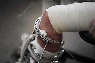 Broken leg