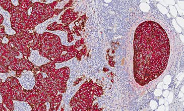 Breast cancer showing HER-2 expression