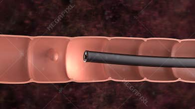 Medical technology with 3d rendering endoscope and colonic polyp in intestine