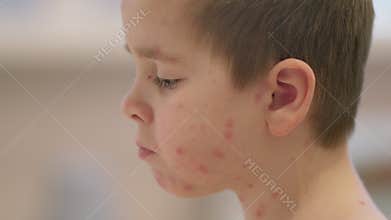 A young child with a noticeable skin condition chickenpox maintains a focused and thoughtful expression