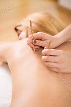Therapist applying acupuncture needle