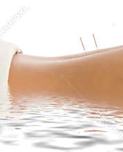 Acupuncture