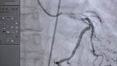 Ultrasound of a Real heartbeat. Ultrasonic examination on computer screen.