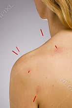 Acupuncture needles shoulder