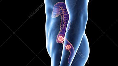 Colon cancer