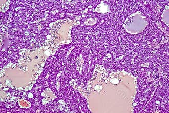 Hepatocellular carcinoma - liver cancer in rat, 60x zoom