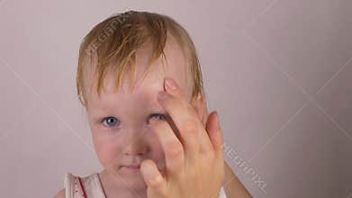 Mother treats a scar wound on the forehead of her little caucasian daughter with a healing cream against allergies and