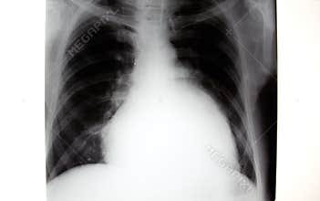 X-ray of chest, enlarged heart