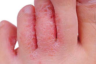 Athlete's foot fungus