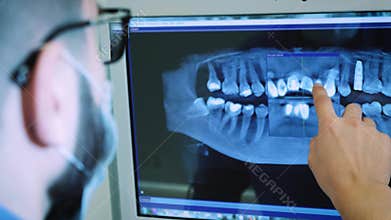 The dentist is studying the x-ray 3D image of the jaw