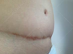 Scars from surgery Abdominal area.