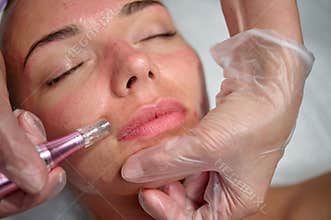 Anti-aging care with dermapen, patient face close-up