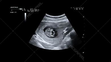 Ultrasonography of Baby in mother`s womb. Ultrasound of baby body and spine. Tiny baby is turning in mother`s belly. 12