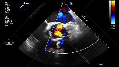 Ultrasound transesophageal examination of the heart.