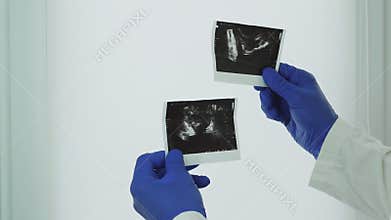 An ultrasound scan of the prostate, in the hands of a doctor, an ultrasound of the prostate gland, an analysis for prostate