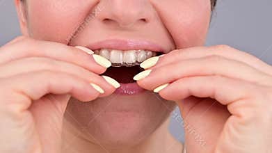 Close-up portrait of a woman putting on a transparent plastic retainer. A girl corrects a bite with the help of an