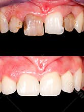 Before - after
