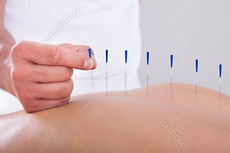 Woman receiving an acupuncture therapy