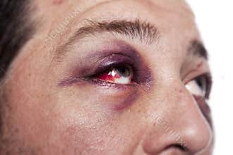 Black eye injury accident violence isolated