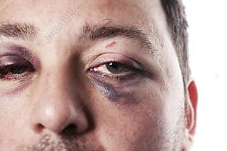 Black eye injury accident violence isolated