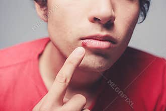 Young man with cold sore