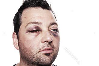 Black eye injury accident violence isolated