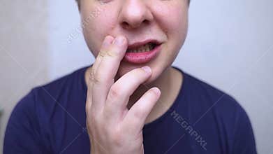 Close-up of a young person showing facial asymmetry, characteristic of facial nerve palsy (Bell's palsy).