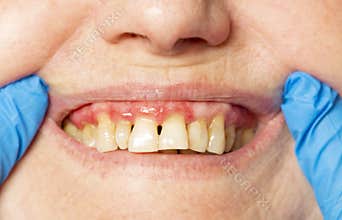 Teeth with periodontitis