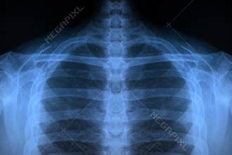 Upper Body X-Ray