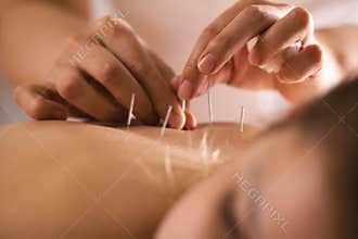 The doctor sticks needles into the girl`s body on the acupuncture